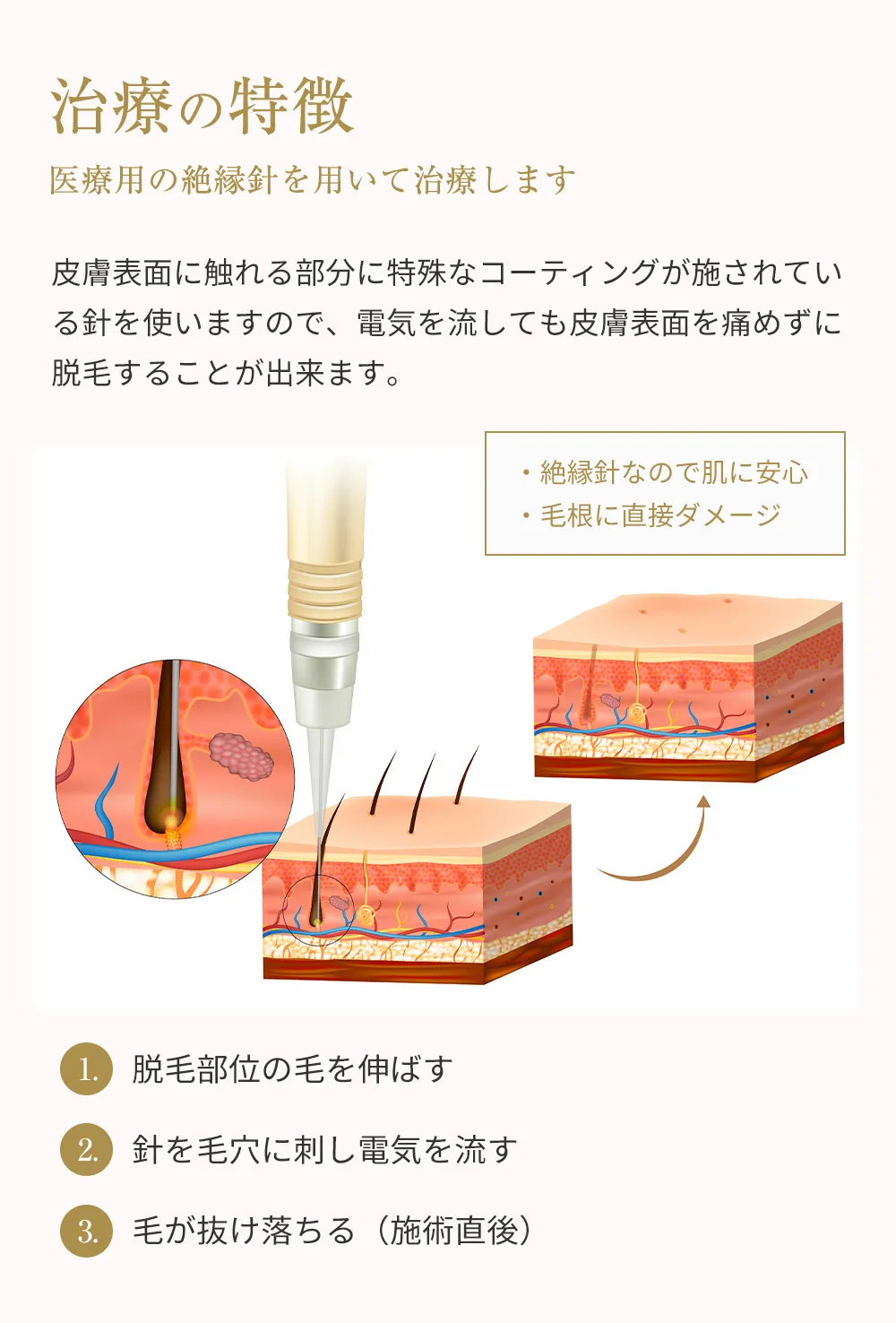 治療の特徴 医療用の絶縁針を用いて治療します