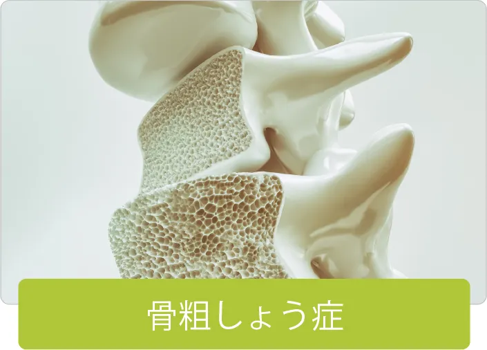骨粗しょう症