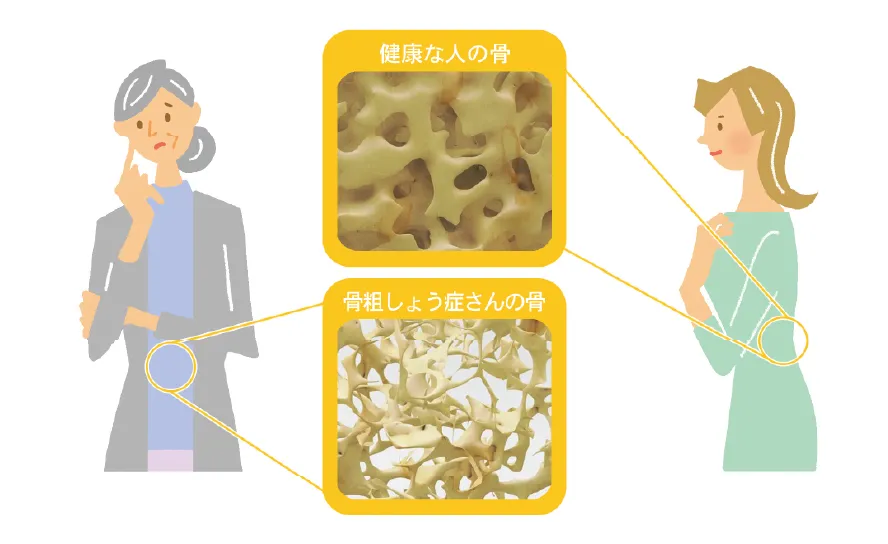 健康な骨と骨粗しょう症の骨との比較